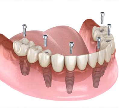 All-on-Four®/All-on-Six® Same Day Teeth - Cassiobury Dental Practice