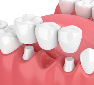 Bridges - Cassiobury Dental Practice