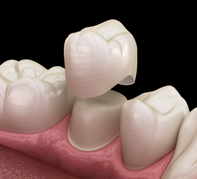 Crowns - Cassiobury Dental Practice