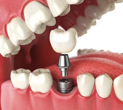 Dental Implants - Cassiobury Dental Practice