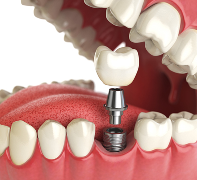 Single Tooth Dental Implants - Cassiobury Dental Practice