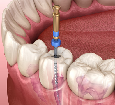 Endodontics - Cassiobury Dental Practice