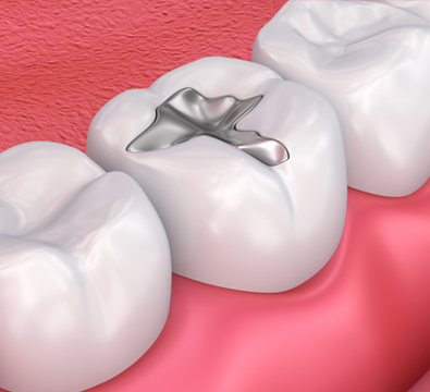 Fillings - Cassiobury Dental Practice