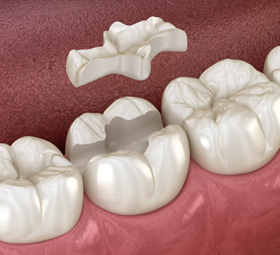 Inlays & Onlays - Cassiobury Dental Practice