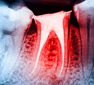 Root Canal Retreatment - Cassiobury Dental Practice