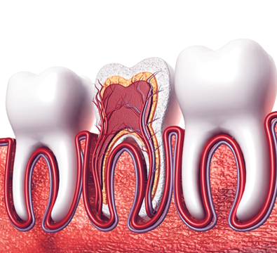 Root Canal Treatment - Cassiobury Dental Practice