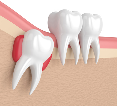Tooth Extraction - Cassiobury Dental Practice