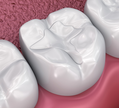 White Fillings - Cassiobury Dental Practice